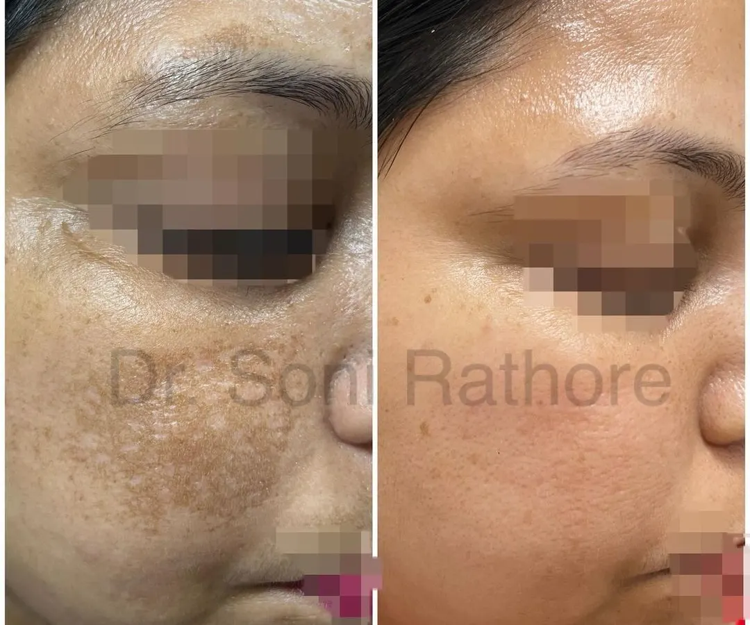 This before and after image showcases a significant reduction in melasma. We achieved this result through a multi-faceted approach including prescription creams, a series of chemical peels for pigmentation, and targeted laser treatments.