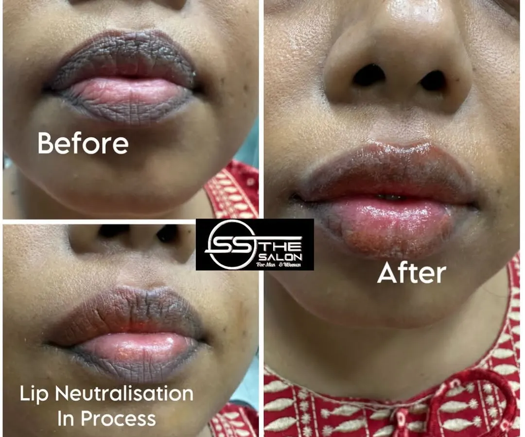 Here you can see the transformative power of my Lip Neutralisation service. This before and after collage shows how I correct dark pigmentation in just one session, resulting in lighter, more evenly toned lips, creating a perfect base for any lip color or a natural look.