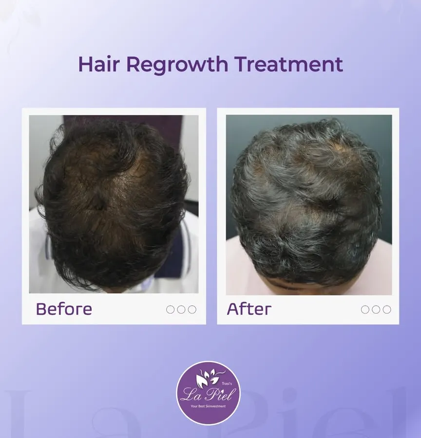 Here you can see the results of a targeted hair regrowth treatment for male pattern thinning. We successfully increased hair volume and scalp coverage, leading to a fuller and healthier appearance.