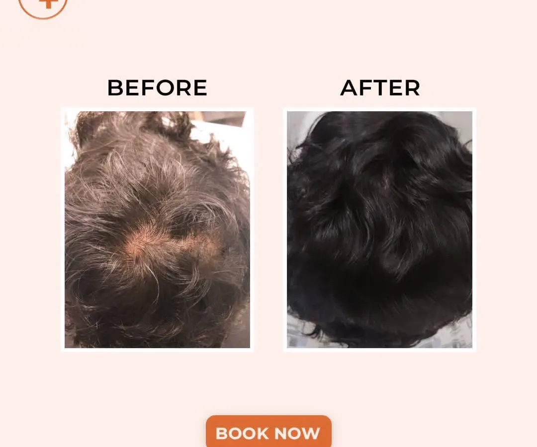 This is the kind of transformation that is possible with a consistent, personalized hair restoration plan. This patient's results show a significant increase in hair density and scalp coverage, restoring not just their hair, but their confidence.