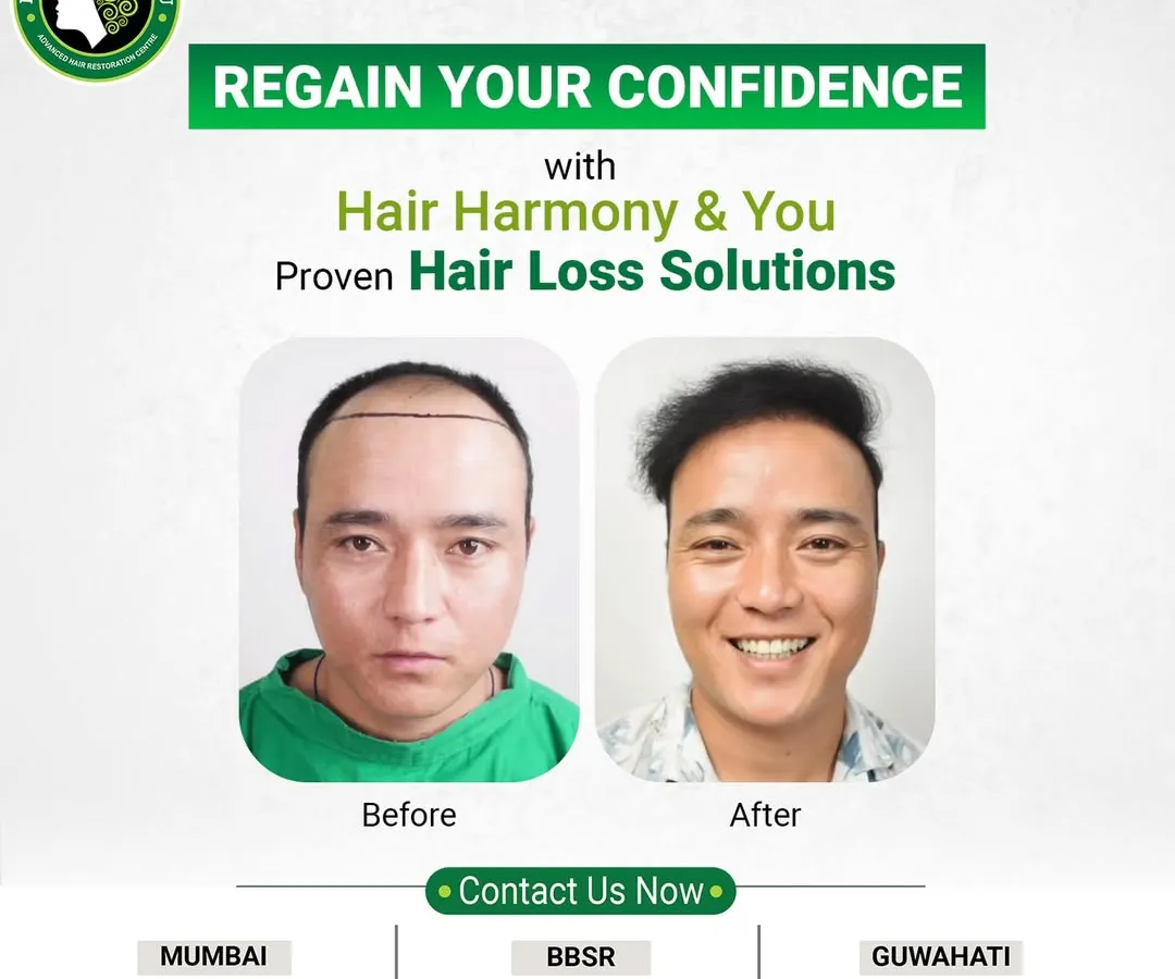 A picture is worth a thousand words, and this before and after comparison says it all. Notice the natural-looking hairline and the incredible boost in confidence, evident in his smile. This is the kind of life-changing result I strive for with every client.