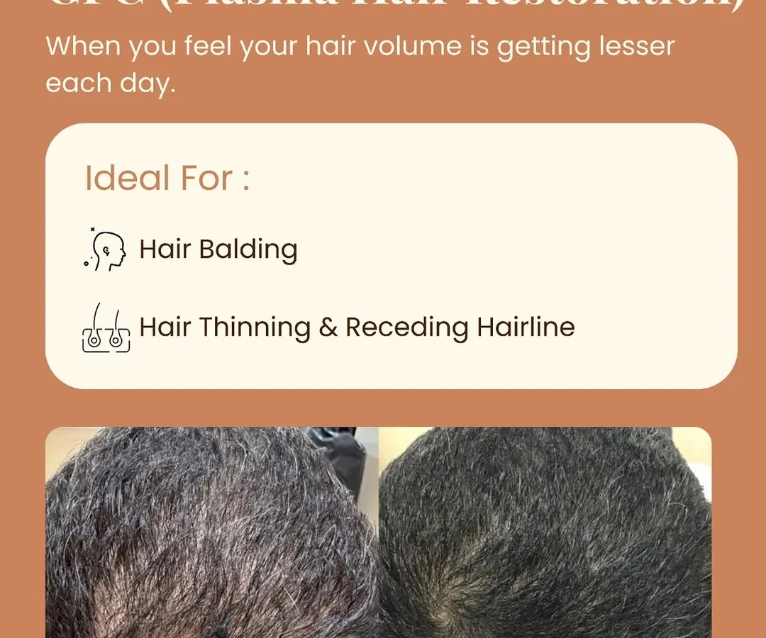 The proof is in the results. This patient saw a significant increase in hair density and coverage after GFC sessions at our clinic. We focus on creating personalized treatment plans because hair restoration is a journey, and results like these are our shared goal.