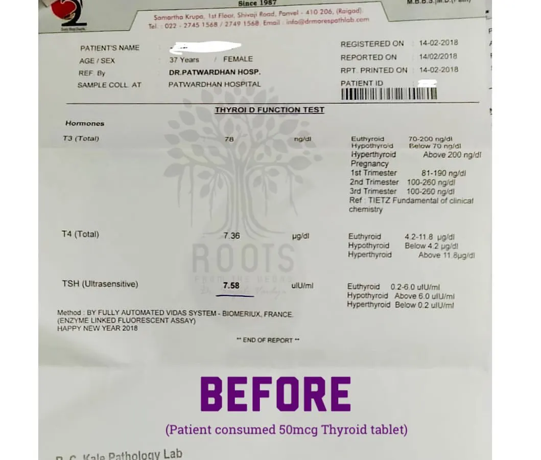 This is a "before" lab report from a patient suffering from hypothyroidism for several years. Even with a 50mcg thyroid tablet, their TSH level was at a high 7.58, indicating the condition was not under control.
