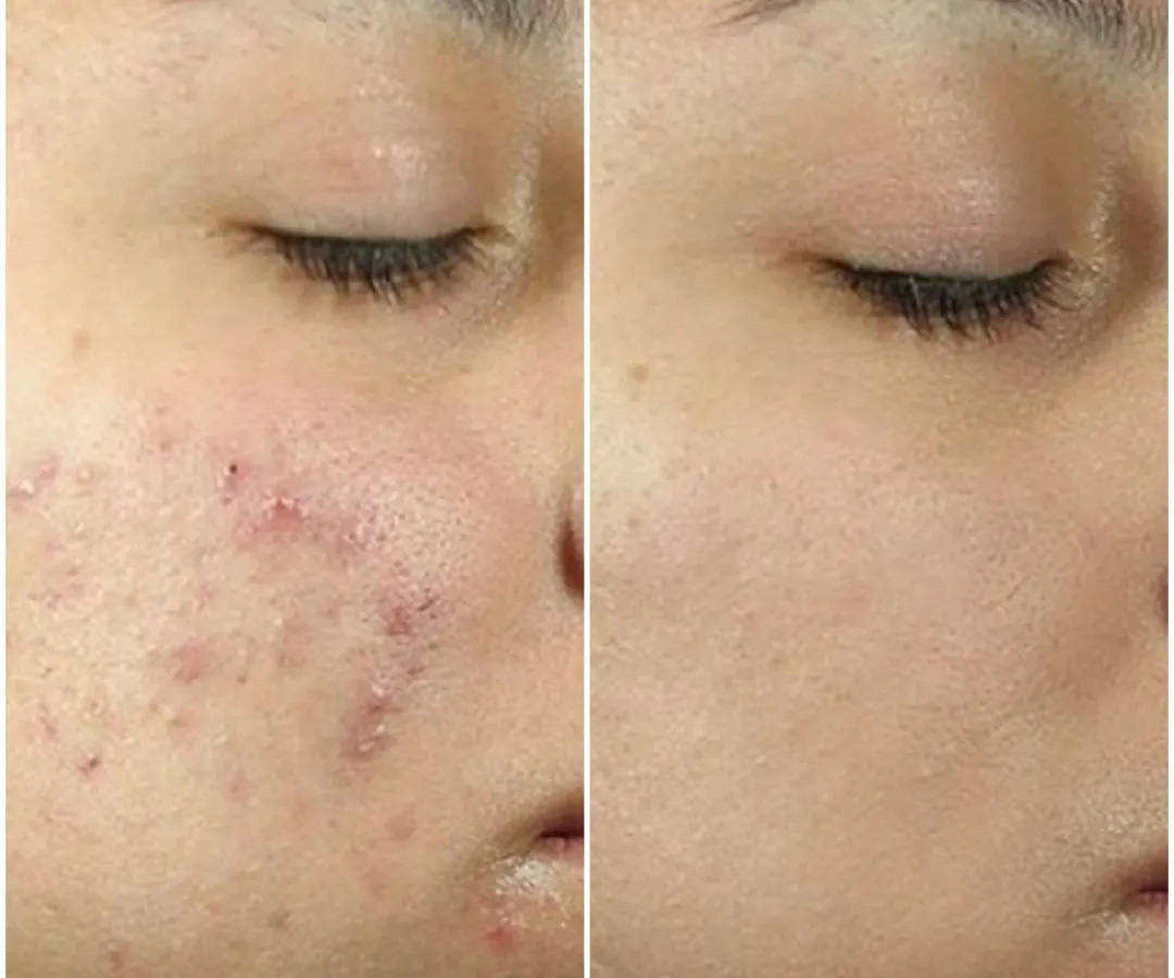 This is a powerful before and after transformation for one of our patients struggling with severe acne and post-inflammatory erythema. Our customized chemical peel treatment plan significantly cleared the breakouts and improved skin texture, revealing healthier skin.