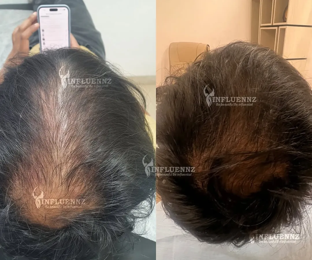 This is the kind of visible result we can achieve. This client's before and after photos show a significant increase in hair density and scalp coverage after completing their personalized hair restoration plan. We focused on reactivating dormant follicles for natural, thicker regrowth.