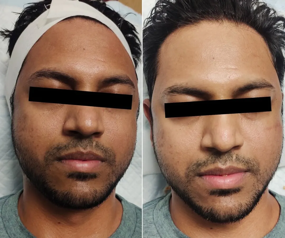 This is a clear example of our effective tan removal treatment. We help restore your skin's natural tone, reversing sun damage to reveal a brighter, healthier complexion. The process is quick, safe, and delivers visible results.