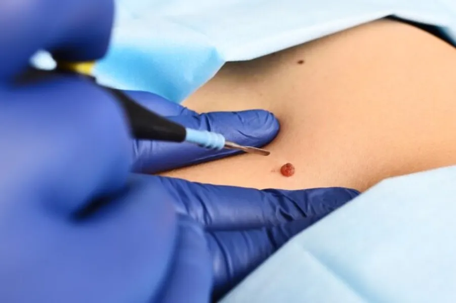 Here you can see the radiofrequency cautery technique in action for mole removal. This method is extremely precise, allowing me to target the growth without affecting the surrounding skin, which is key to minimizing scarring and ensuring a clean, aesthetic result.