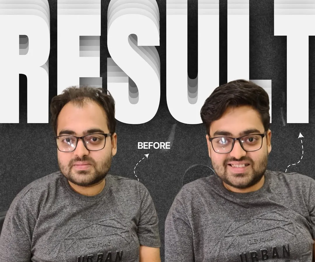 This graphic perfectly captures the confidence boost that comes with our non-surgical hair replacement systems. For this client, we designed a custom hairpiece that integrates flawlessly with his existing hair, restoring his hairline and creating a fuller, more youthful appearance.