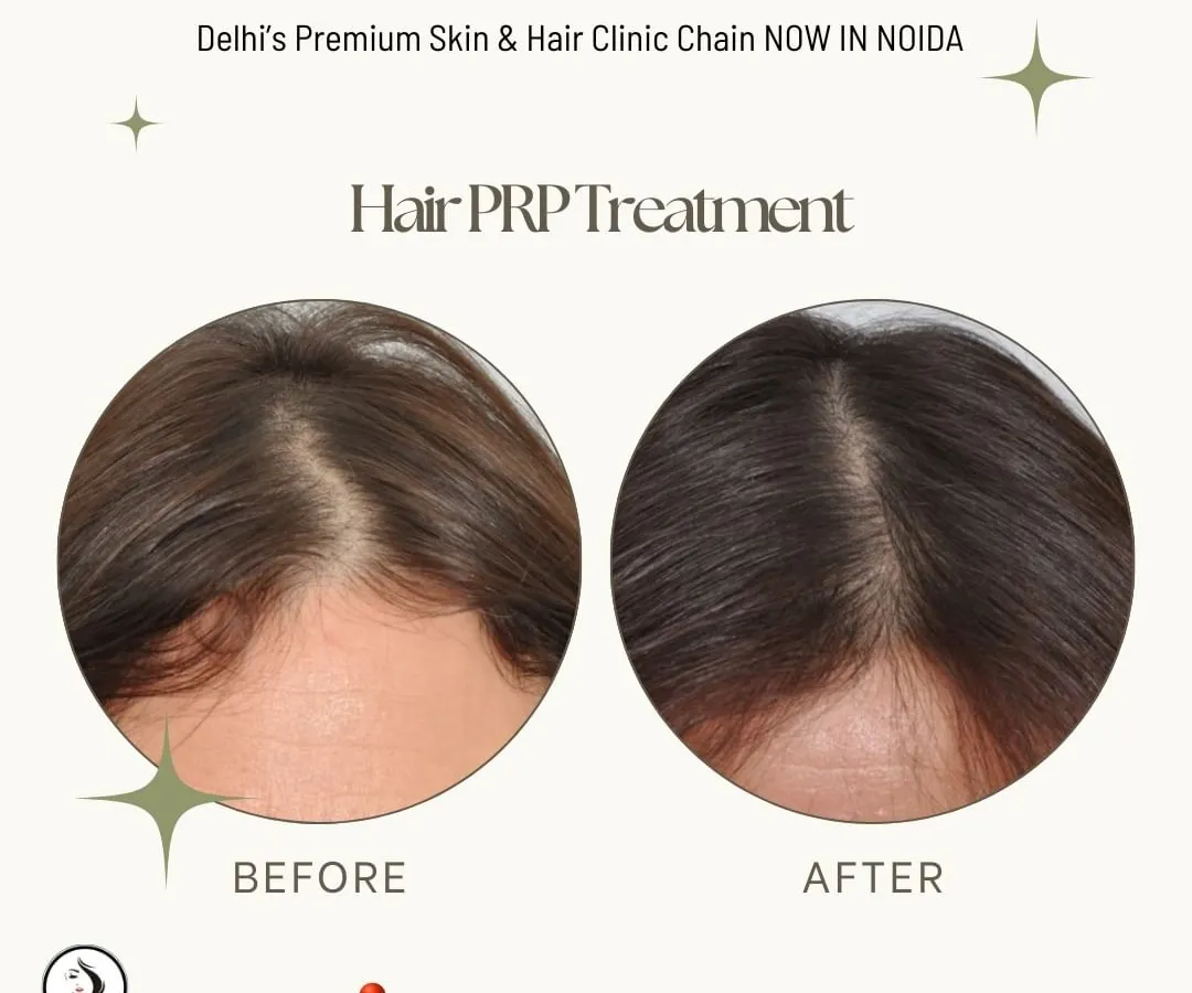 A clear before and after view of a client's scalp, demonstrating a visible reduction in the parting width and improved hair thickness. Our Hair PRP treatment effectively addresses diffuse hair thinning by stimulating dormant hair follicles.