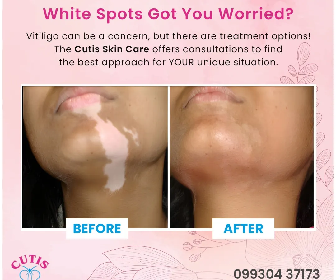 We specialize in compassionate and effective vitiligo treatment. This before and after result demonstrates how our personalized treatment plans can significantly restore skin pigmentation on the face, helping patients regain an even skin tone.