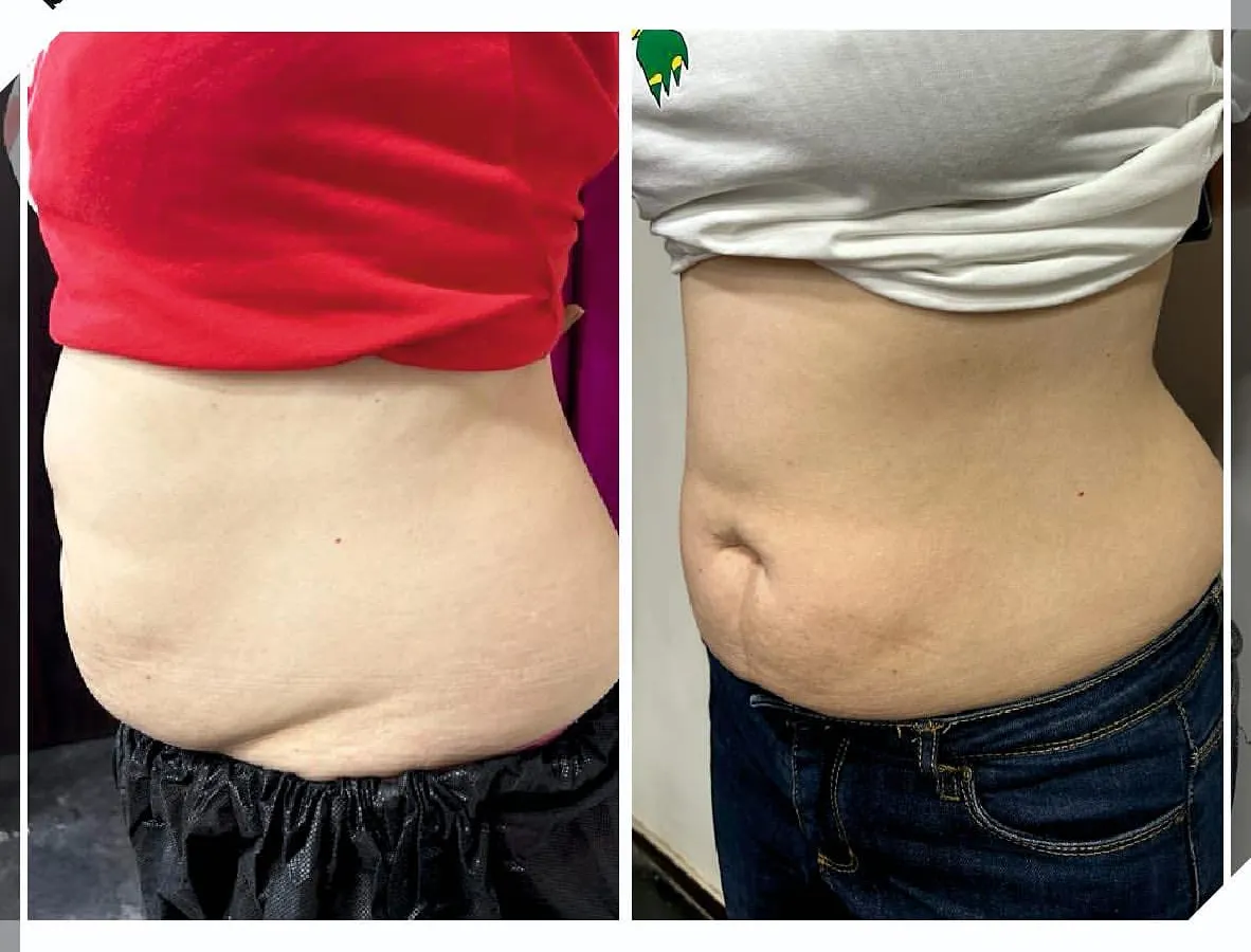 This is the result of our Tummy Contouring program after just one session of Cristal Pro. We focus on reducing stubborn belly fat and tightening the skin, helping our clients feel more confident and comfortable.