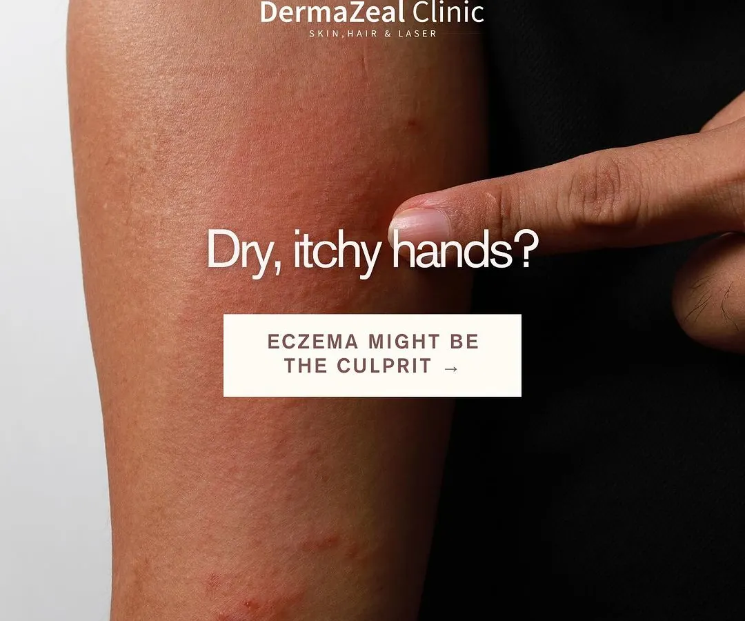 Persistent dry, itchy, and inflamed skin on your hands or body is often more than just simple dryness. It could be hand dermatitis or eczema, a condition that requires a proper diagnosis to manage effectively and prevent future flare-ups.