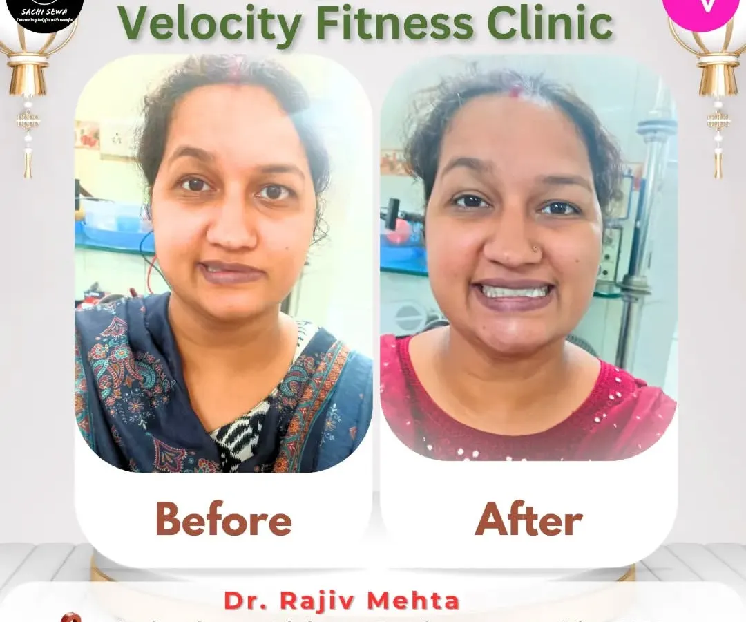 This is one of the most rewarding parts of my work. This patient came to me for Bell's Palsy treatment, and this before and after image shows the incredible progress we made together, restoring her smile and facial control.