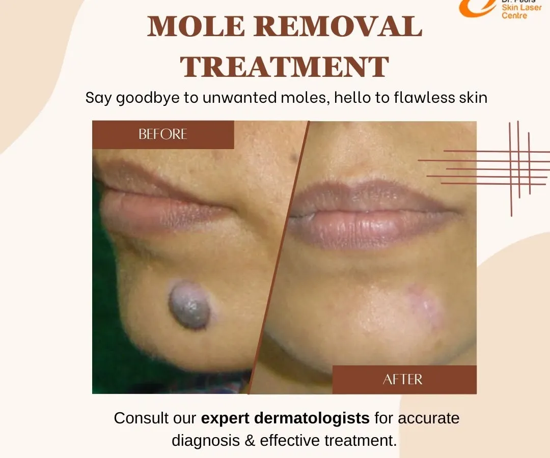 Unwanted moles can be a cosmetic concern for many. Here you can see a prominent, raised mole on the chin before the procedure and the clear, smooth skin after my CO2 laser removal treatment. The process is precise and aims for a minimal to scar-free result.