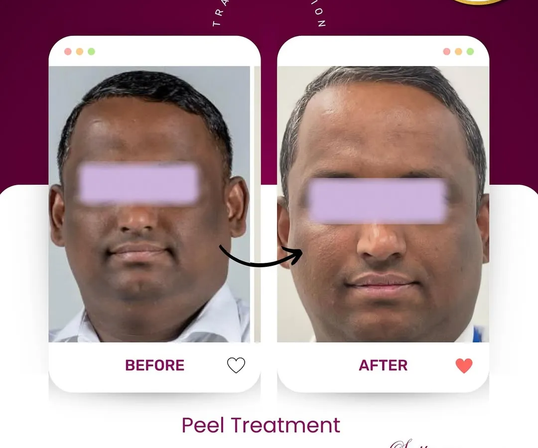 Real results speak for themselves. This is a transformation achieved with a customized chemical peel treatment plan designed to address specific skin concerns, revealing a brighter, more even-toned complexion underneath.