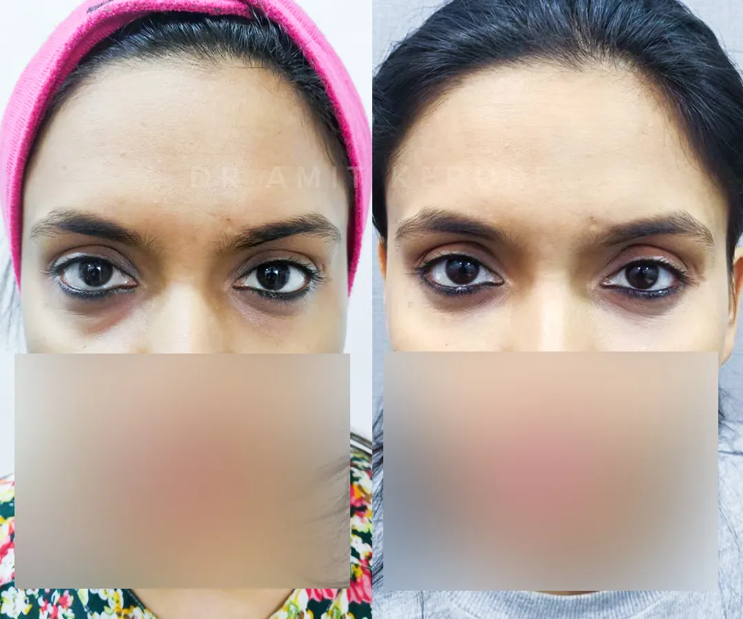 Here you can see the immediate effect of tear trough fillers. This non-surgical treatment restores volume under the eyes, significantly reducing the appearance of hollows and dark circles for a refreshed, well-rested look.