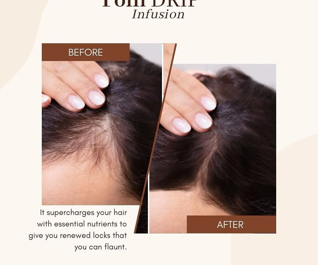 The results speak for themselves. This before and after showcases the transformative effect of our Folli IV Drip infusion. By delivering essential nutrients directly into the bloodstream, we supercharge hair follicles from within to promote renewed, thicker locks.