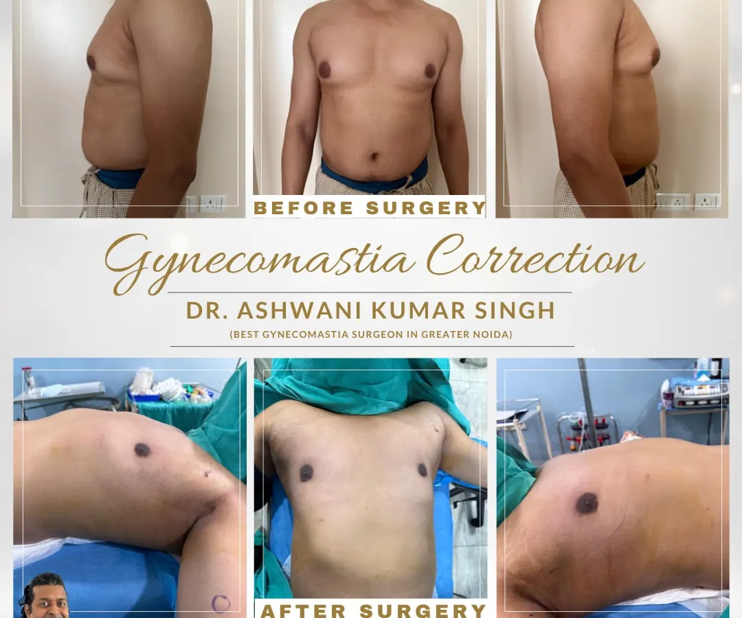 This patient's transformation through Gynecomastia surgery shows a significant change in chest contour. I carefully removed excess glandular tissue and fat to create a flatter, more masculine chest. Notice the improved definition from both the front and side profiles.