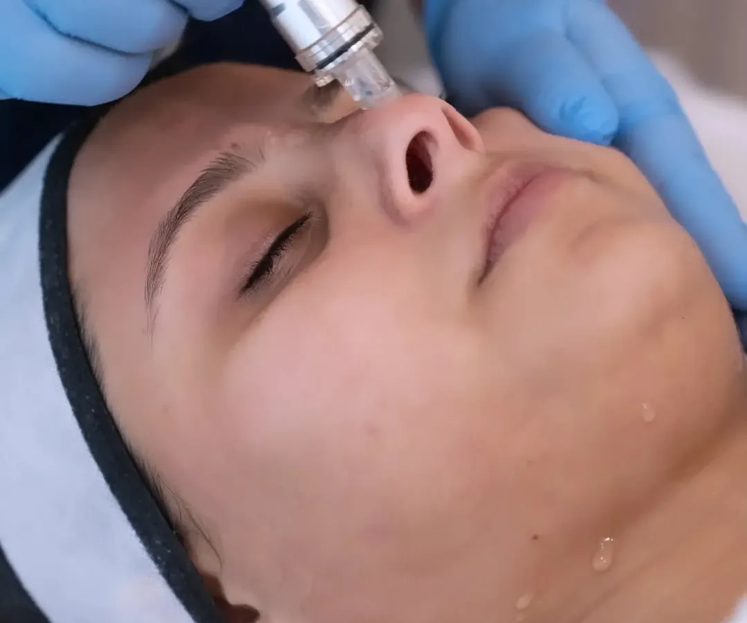 Here you can see the HydraPro tool in action. This is a key part of my deep hydration facial, using advanced technology to gently exfoliate and infuse the skin with moisture for that instant, dewy glow.