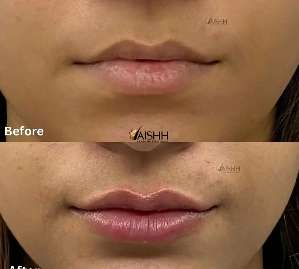 My goal with lip fillers is always harmony and balance. Here, I carefully added subtle volume and enhanced the natural shape of the lips, avoiding an overdone look. The result is fuller, more defined lips that perfectly complement the patient's features.