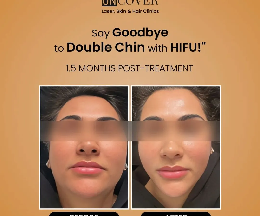 Here is a clear example of what HIFU can achieve. This client was concerned about her double chin, and these are the results just 1.5 months after her treatment. Notice the significant reduction in submental fat and the newly defined, sharper jawline. This is non-surgical fat reduction at its best.