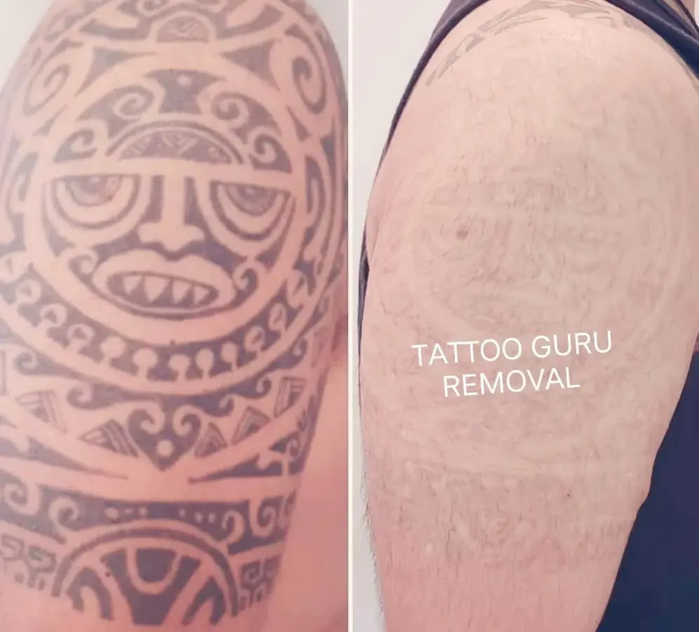 Removing a large, dense tribal tattoo like this one on the shoulder takes time and multiple sessions. This before and after photo shows the significant fading possible, clearing the skin for a fresh start.
