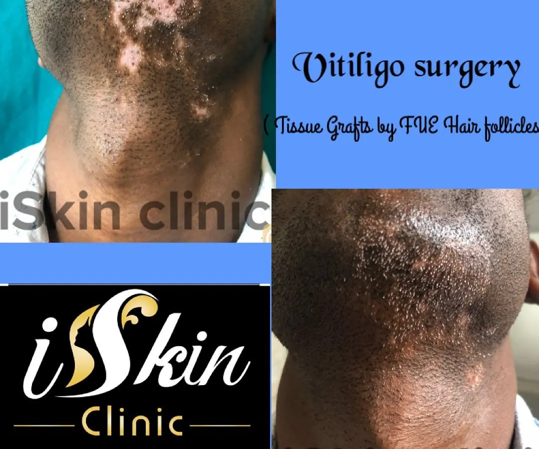 Here we demonstrate the results of a vitiligo surgery on the neck. Using a technique involving tissue grafts from FUE hair follicles, we were able to transplant pigment-producing cells to the depigmented area, achieving significant repigmentation for the patient.