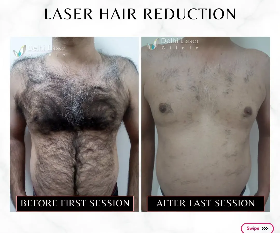 This before and after image shows the significant reduction in chest hair for a male client after completing his sessions. The treatment not only removes unwanted hair but also results in finer, sparser regrowth over time, simplifying your grooming routine for good.