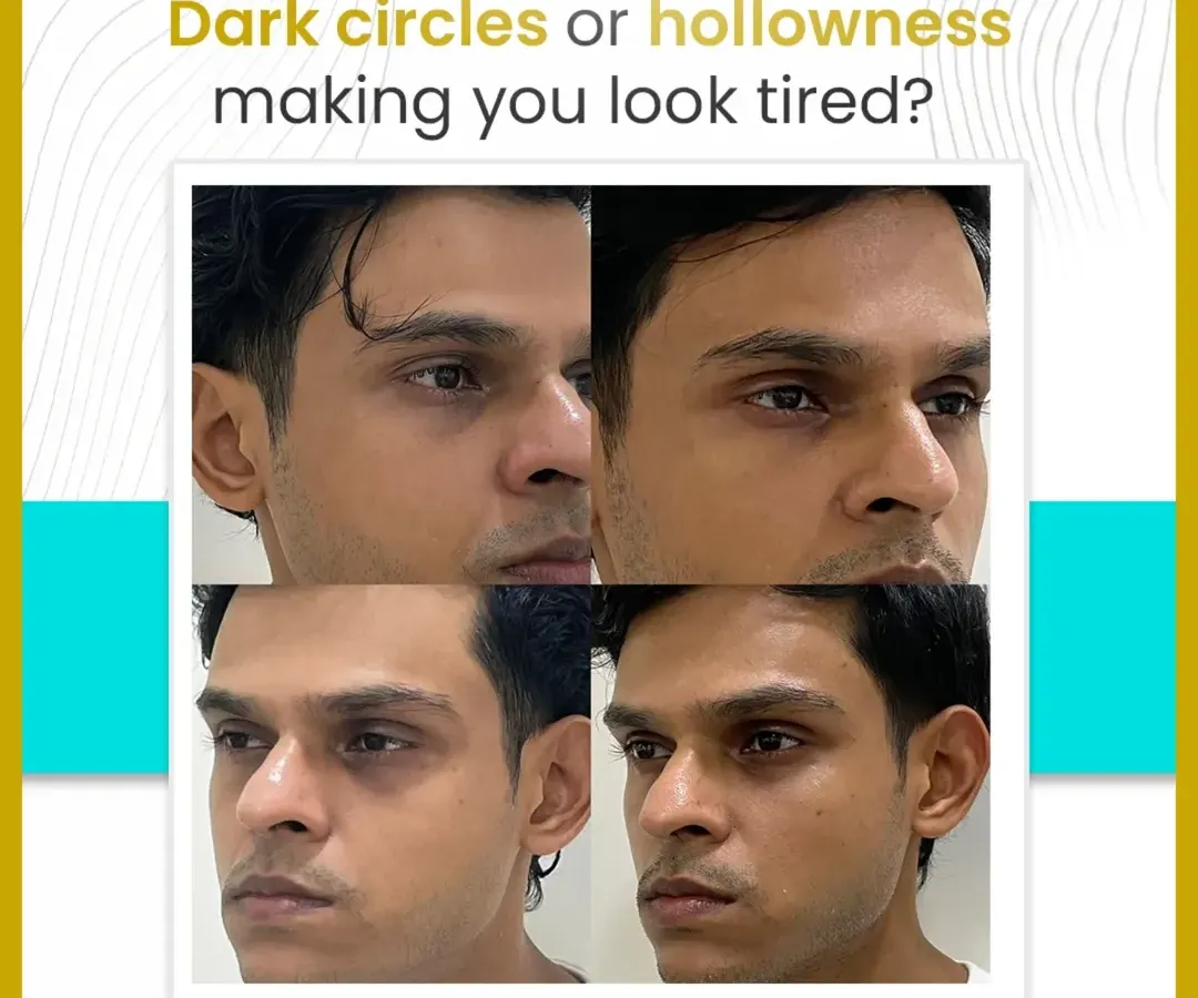 Hollowness and dark circles under the eyes can make you look tired regardless of how much you rest. Here, you can see the significant yet subtle improvement achieved by addressing volume loss, resulting in a brighter and more rested look for my patient.