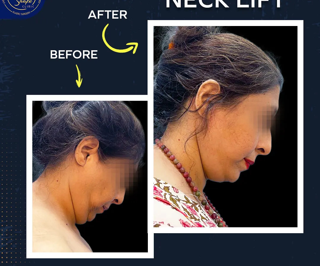 A defined jawline and a smooth neck can dramatically change your profile. This is a real result from a neck lift procedure I performed, showing a significant improvement in skin laxity and contour. It’s about restoring a youthful frame to your face.