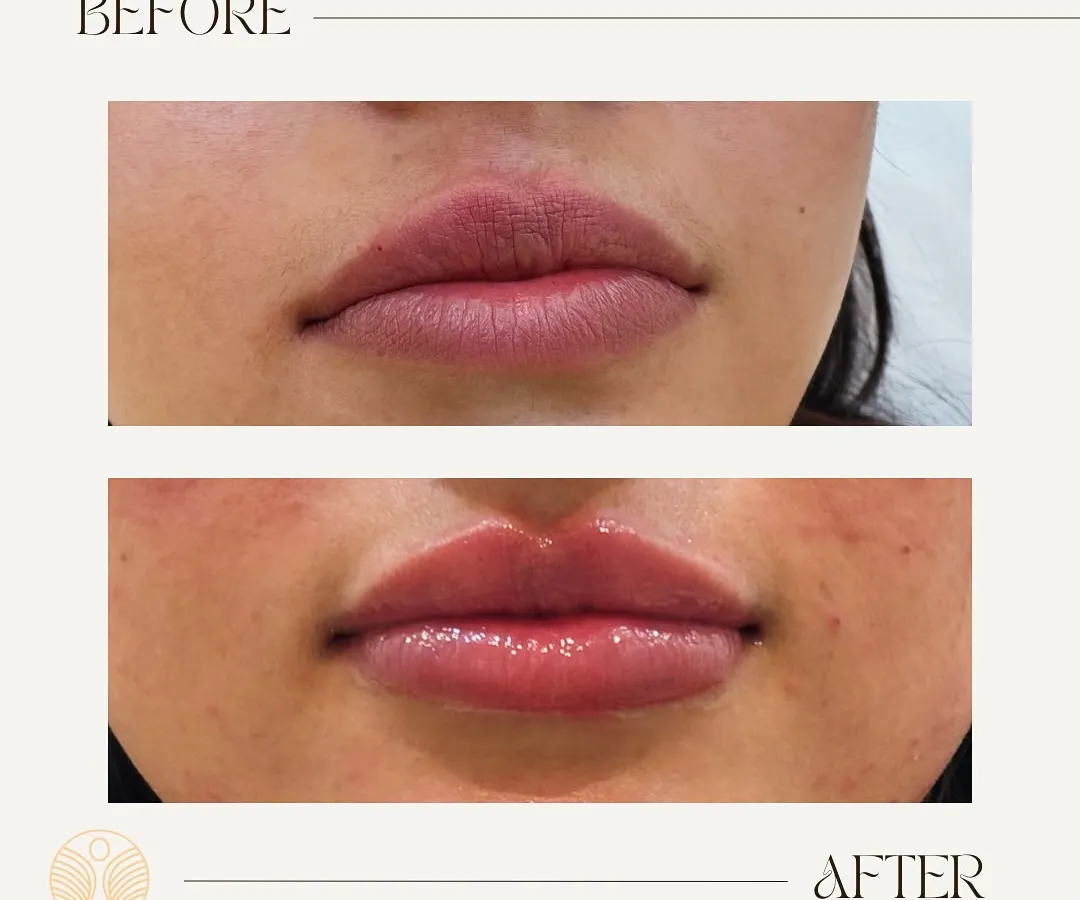 A perfect example of my philosophy on lip fillers: enhancement, not exaggeration. Here, I focused on adding subtle volume and hydration to create a beautifully balanced and natural-looking pout.