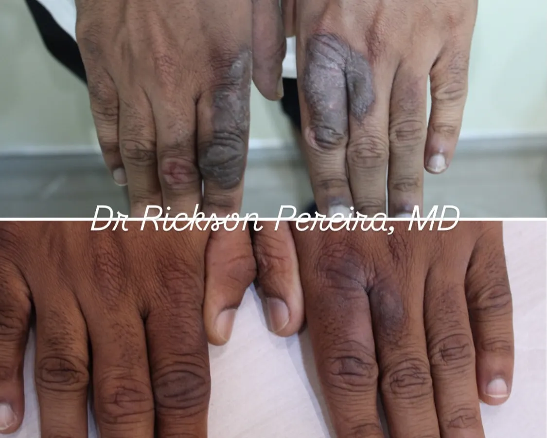 After two years of struggling with chronic hand eczema that interfered with daily life, this patient found relief. We used a targeted combination of Alma Hybrid laser and topical therapy to resolve the inflammation and itching completely in two months, avoiding the need for systemic medications.