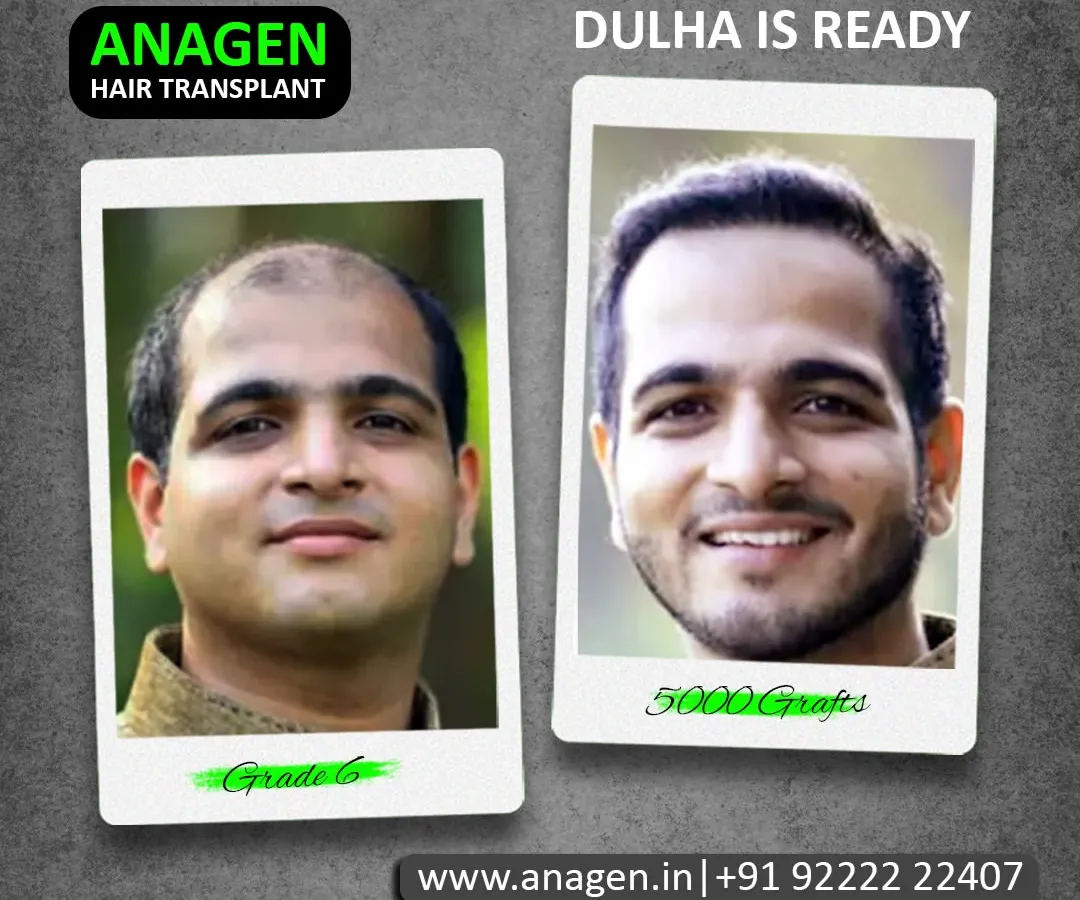 This transformation is why I do what I do. We took this patient from Grade 6 baldness to being "Dulha is Ready" with a 5000 graft procedure. Seeing this smile and renewed confidence is the ultimate reward.