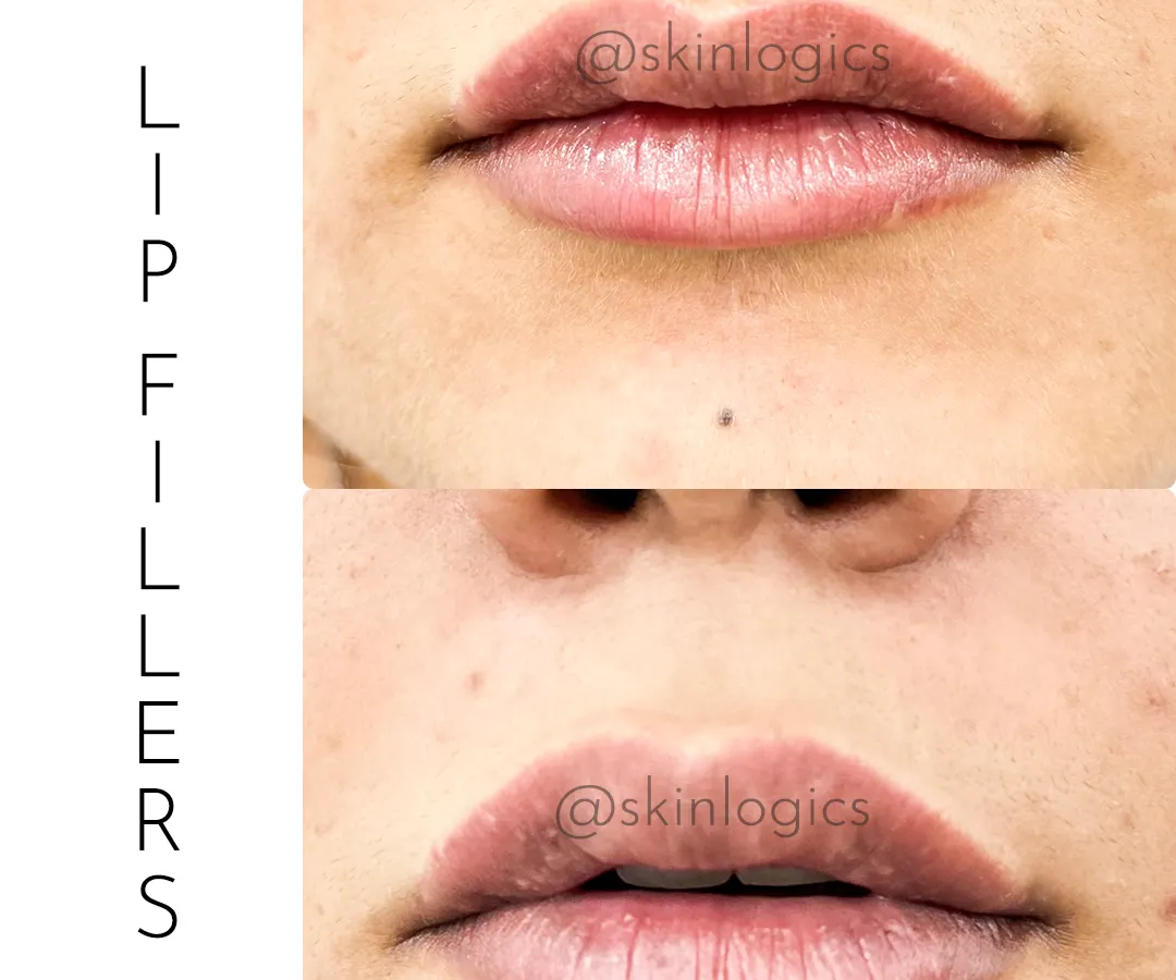 A clear example of how I approach lip fillers. The goal is always a natural enhancement, adding subtle volume and definition to create a balanced and hydrated look, not an overdone pout. This before-and-after shows a beautifully refreshed and defined lip shape.