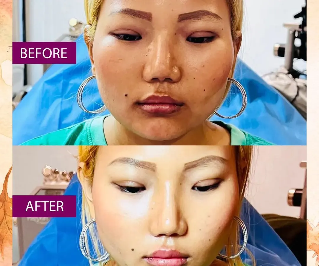 This is a great example of how a combination of treatments can achieve a significant yet natural-looking result. For this patient, I used a thread lift to contour the lower face and jawline, paired with Botox to refine the overall shape. The goal was to create a slimmer, more defined facial structure.