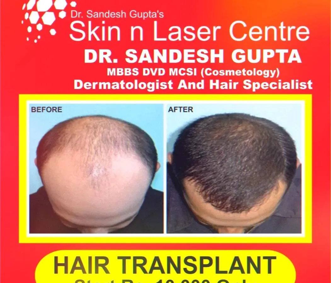 This is a clear example of how a successful FUE hair transplant can completely restore a natural-looking hairline and reverse advanced baldness. The results are permanent, giving you back not just your hair, but your confidence.