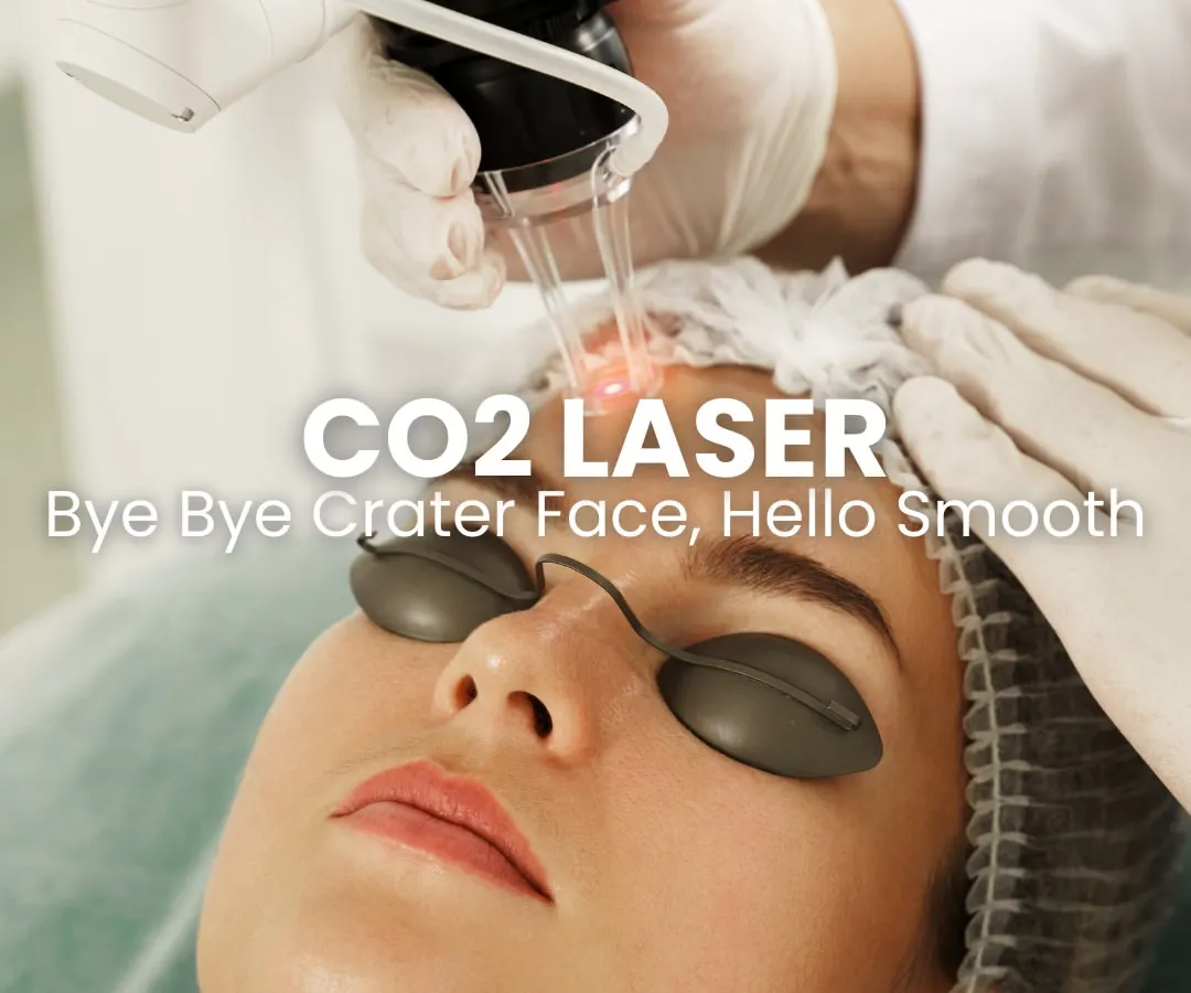 This is the CO2 laser in action. It is one of our most effective tools for treating deep, pitted acne scars, often called "crater face." The laser works by resurfacing the top layer of skin and stimulating new collagen deep within, leading to a significantly smoother and more even texture.