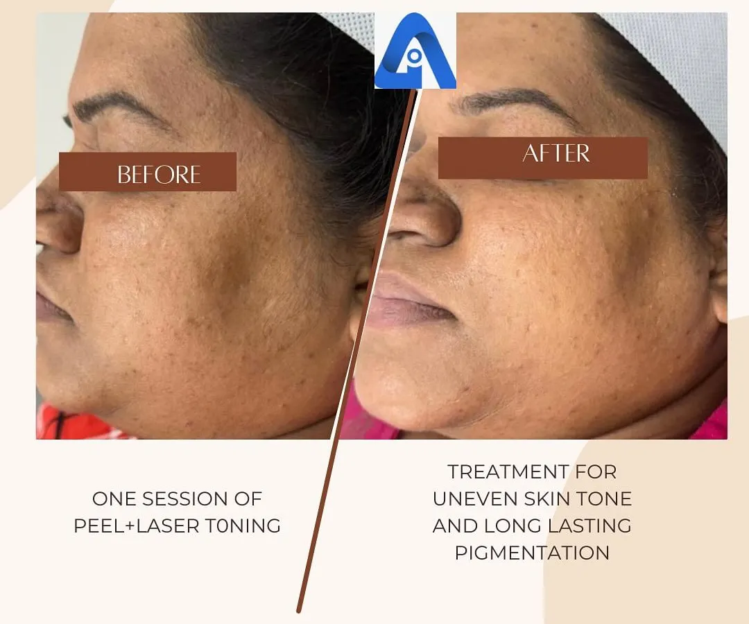 This is a real result from one of my patients after just a single session combining a chemical peel and laser toning. We targeted long-standing pigmentation and uneven skin tone, and you can see a significant improvement in clarity and texture.