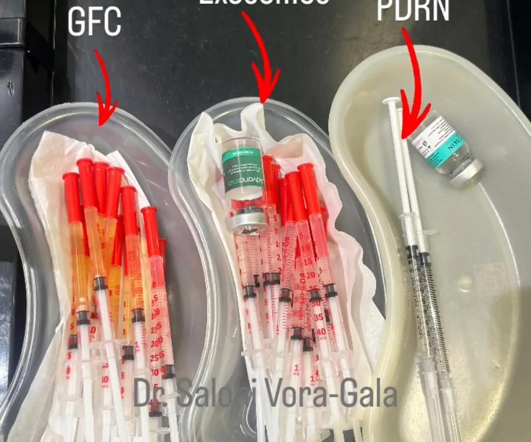 This is what science-backed hair restoration looks like. In my clinic, we use advanced regenerative treatments like GFC (Growth Factor Concentrate), Exosomes, and PDRN. These are not magic potions; they are powerful biological tools that signal your own body to heal, repair, and stimulate hair follicles at a cellular level.