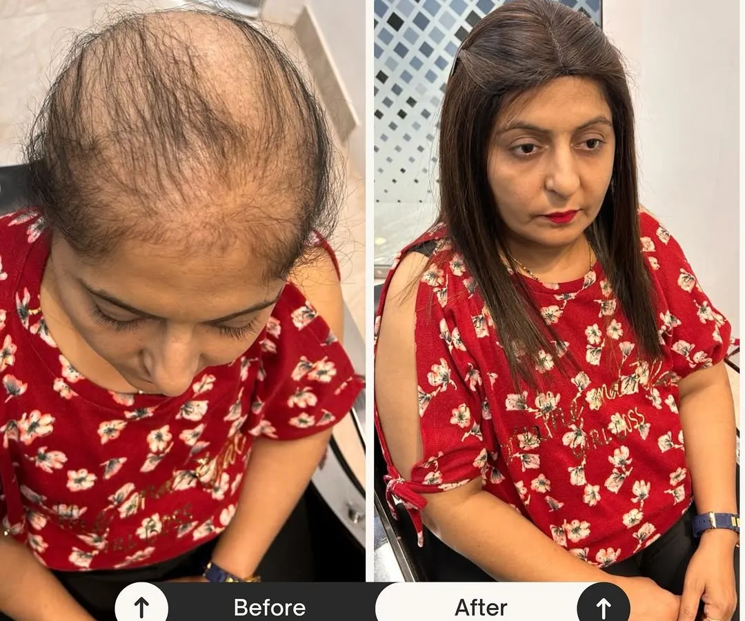 Dekhiye the difference a simple hair topper can make. For clients experiencing thinning on the crown, a high-quality topper blends in perfectly, providing instant volume and a seamless finish. It’s a small change that makes a huge impact on your daily confidence.