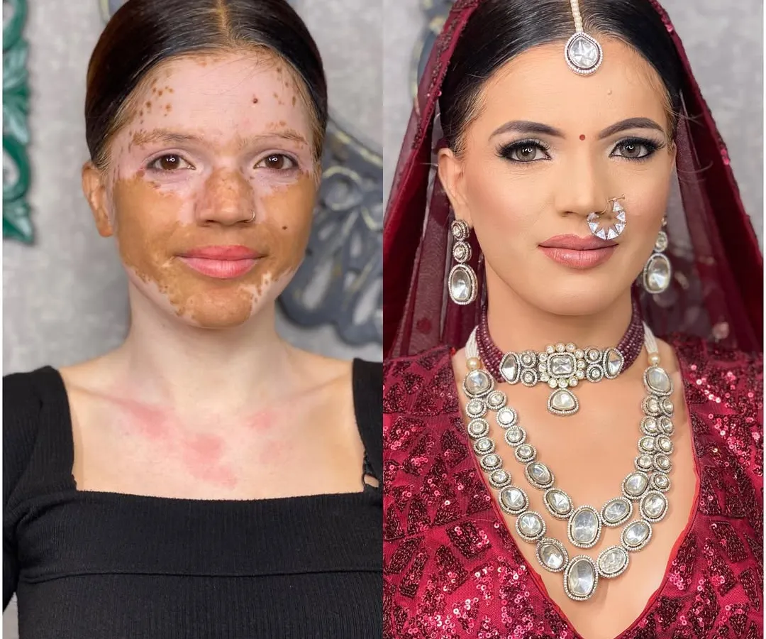 I believe every skin is beautiful, and makeup is a tool to celebrate it. This is a powerful before and after transformation for a client with vitiligo, showing how I create a smooth, even-toned, and radiant bridal look while respecting and honouring her unique skin.