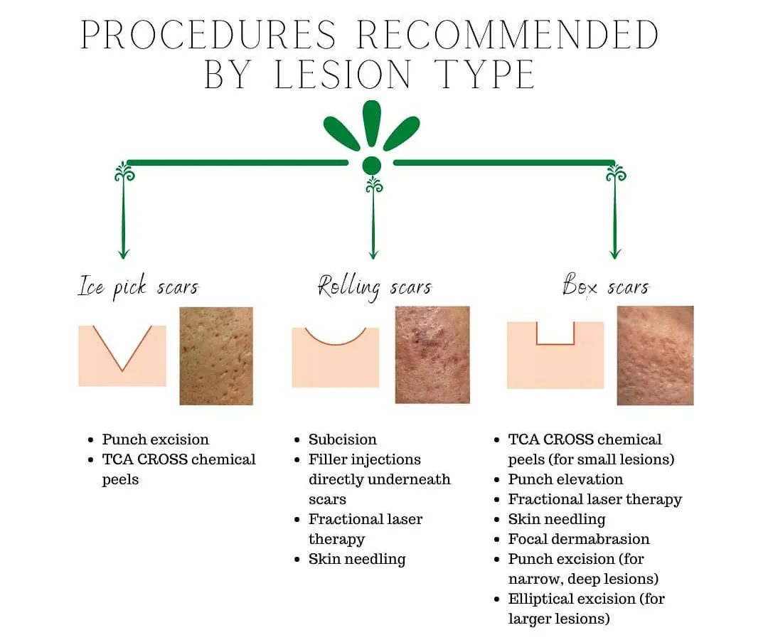 Understanding your specific type of acne scar is the first step toward effective treatment. This guide shows the different procedures I recommend for ice pick, rolling, and boxcar scars, allowing us to create a targeted plan together.