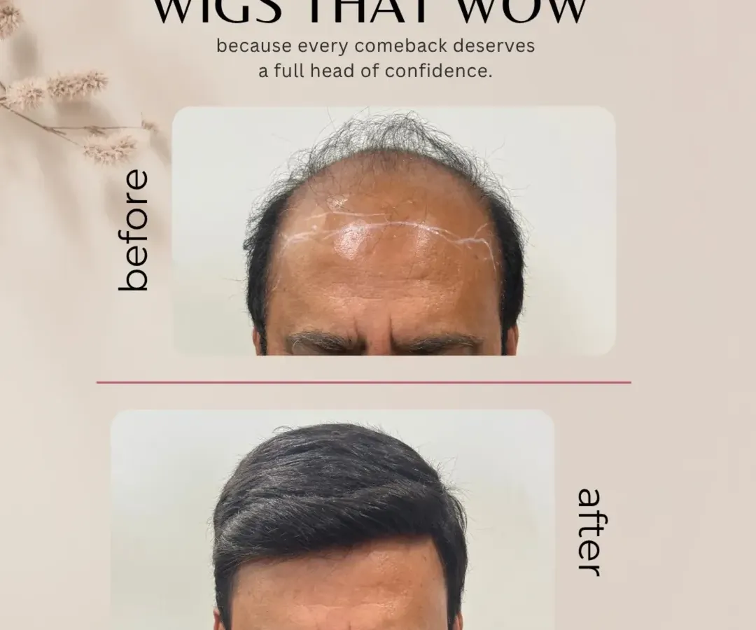 For those seeking an immediate and dramatic change without surgery, I offer custom hair systems. This before and after showcases a complete transformation, providing a full head of hair that blends seamlessly and restores confidence instantly.