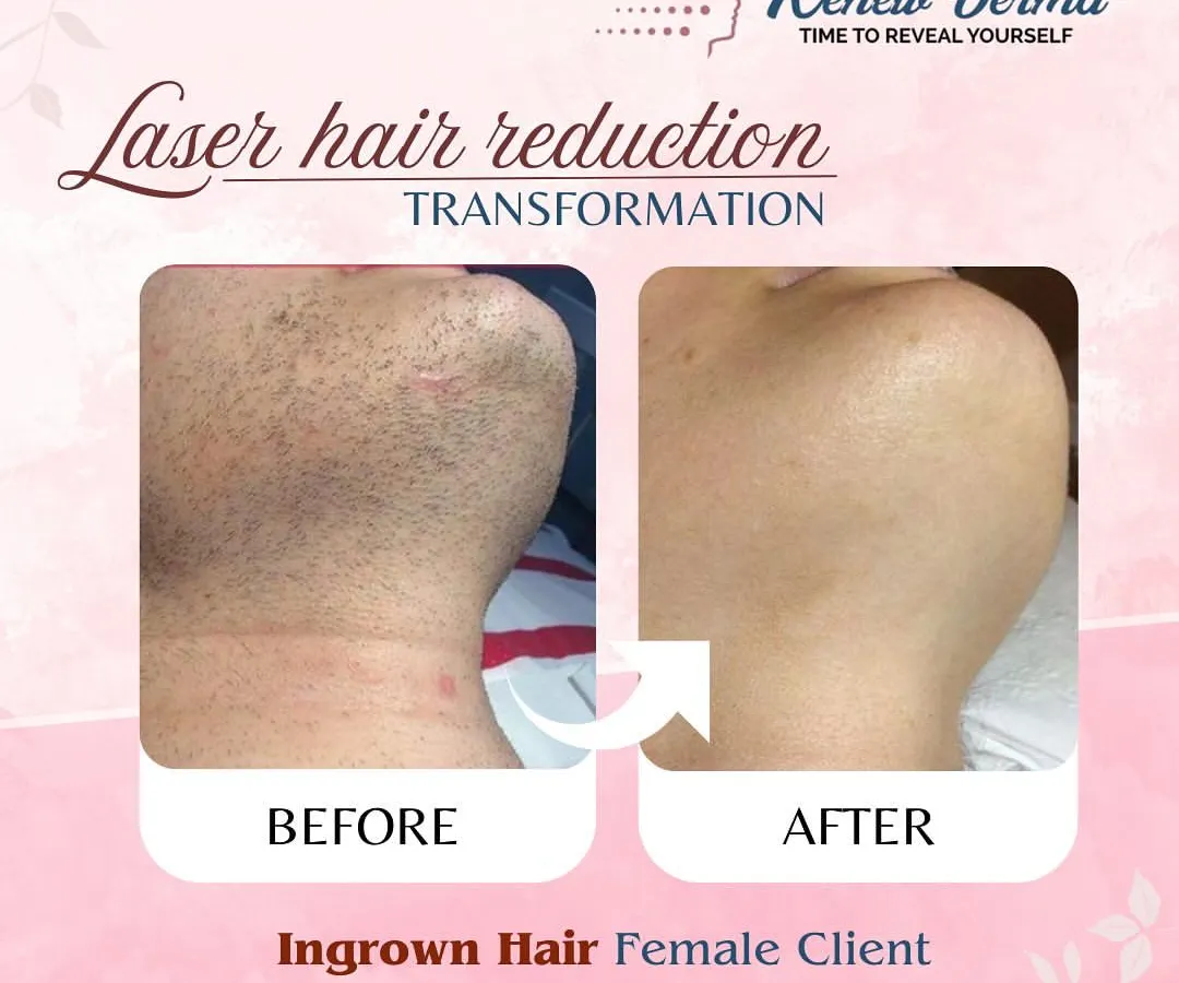 This is why I love what I do. We helped this client get rid of painful and persistent ingrown hair on her chin and neck area. The 'after' photo shows completely clear, smooth skin with no more irritation, a common result of our precise laser hair reduction treatment.
