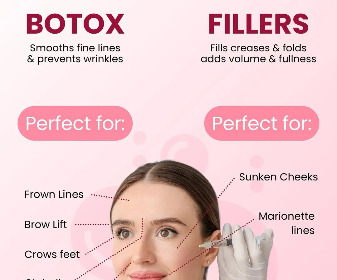 This infographic clearly explains the difference between Botox and Fillers, two of the most effective tools I use for anti-aging. Botox is for smoothing dynamic lines caused by expressions, while fillers are used to restore volume to areas like sunken cheeks. I use both to create a refreshed, natural look.