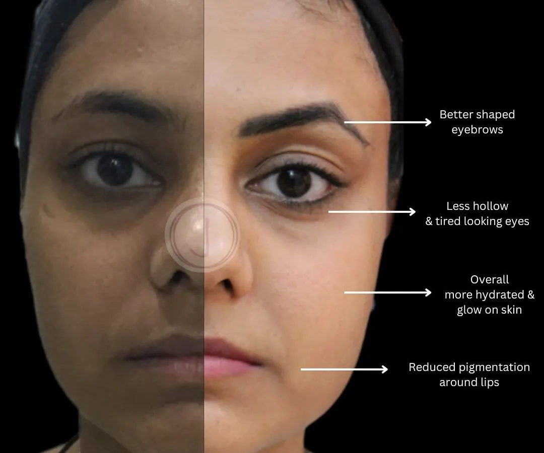 Permanent eyebrows can transform your entire face. This client's journey involved a combination of treatments over time. Along with improving skin hydration and reducing pigmentation, we defined her brows. Notice how the new, better-shaped eyebrows frame her eyes, making them appear less tired and bringing a balanced look to her entire face.
