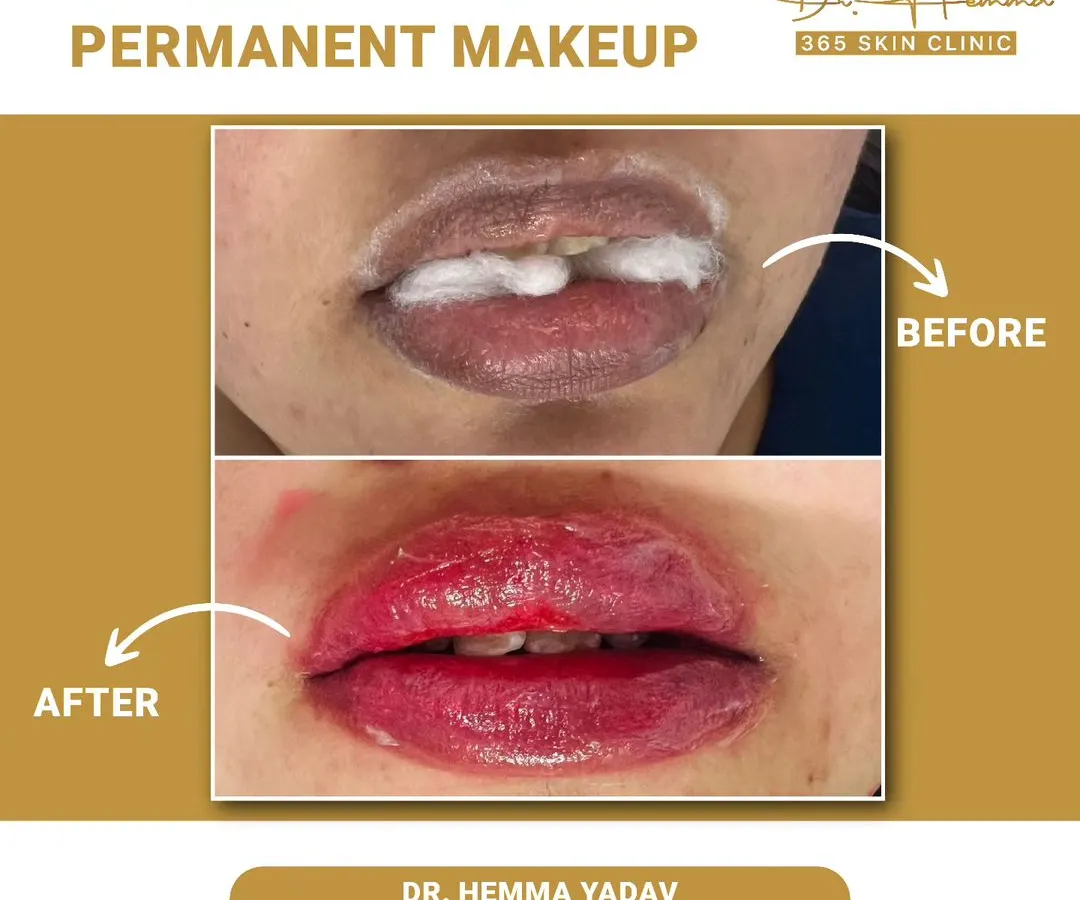 Here you can see the immediate result of a permanent lip blush procedure. We corrected uneven pigmentation and added a healthy, natural color, which is perfect for an effortless look, especially for big events like a wedding.