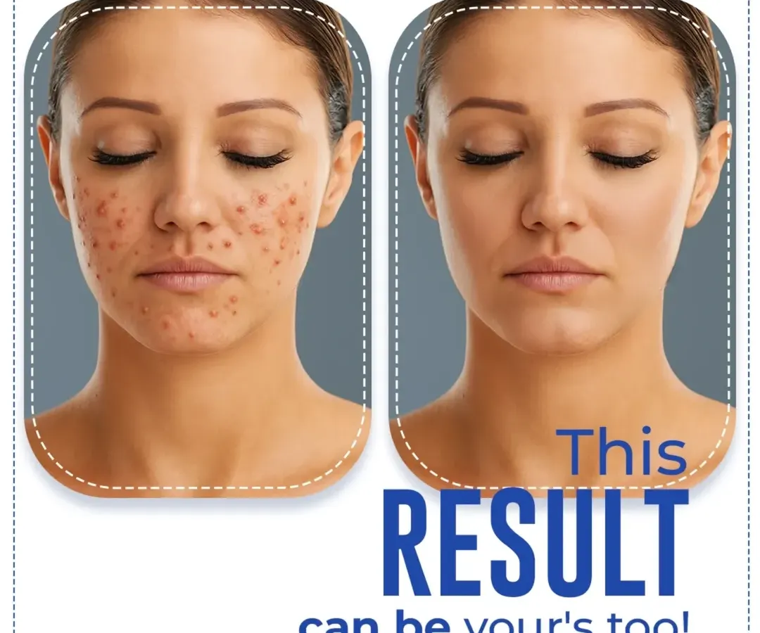 This is a result that can be yours. This before and after showcases the power of laser resurfacing for treating acne scarring and uneven texture. The treatment works by removing damaged outer skin layers and stimulating new collagen, resulting in smoother, clearer skin. This kind of transformation is possible with a targeted, professional treatment plan.