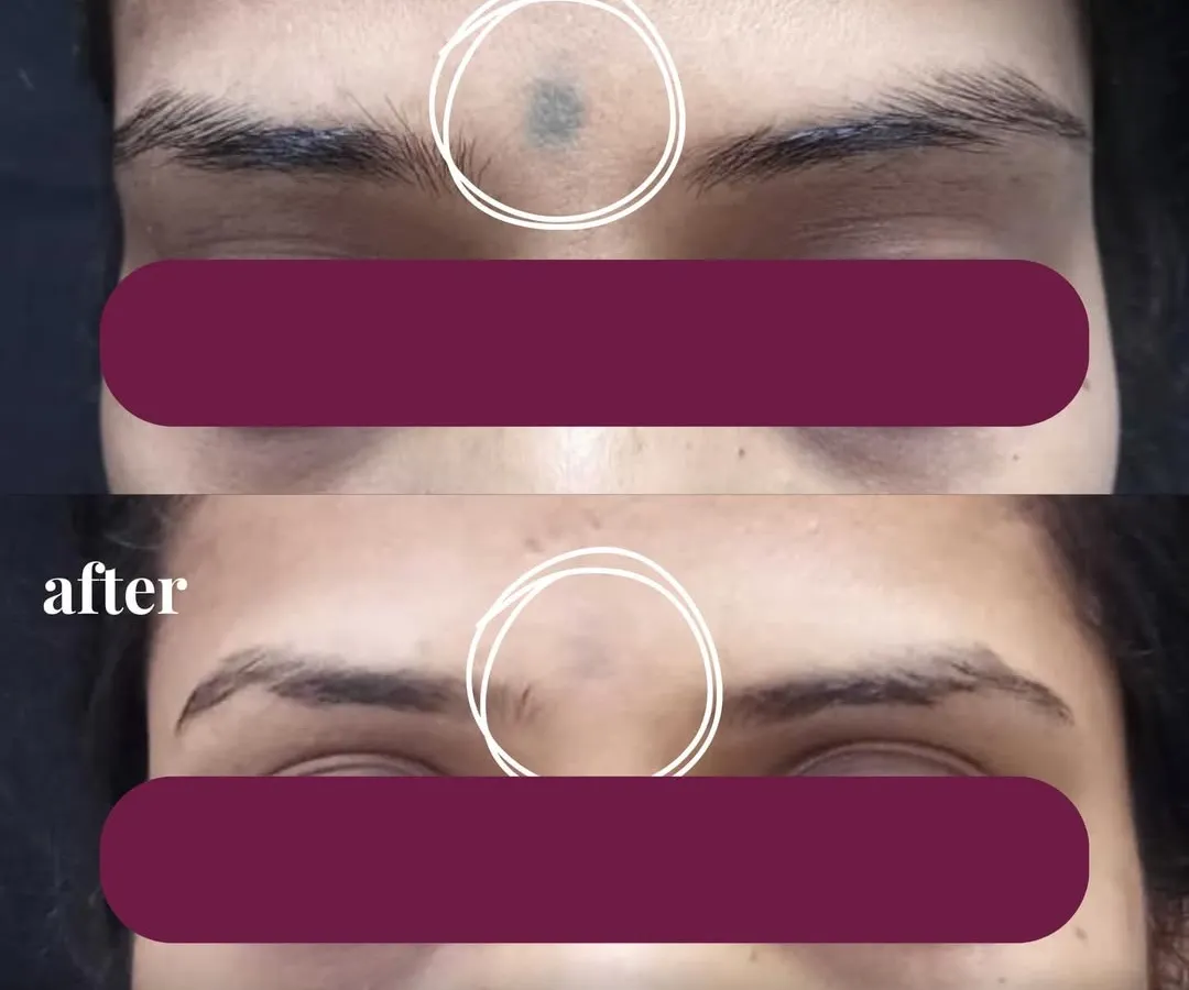 Here you can see the significant fading of a facial tattoo after a course of laser tattoo removal sessions. My approach focuses on gradually breaking down the ink pigment with each treatment, allowing the body to clear it naturally. This ensures the skin's integrity is protected while achieving clear, impressive results.