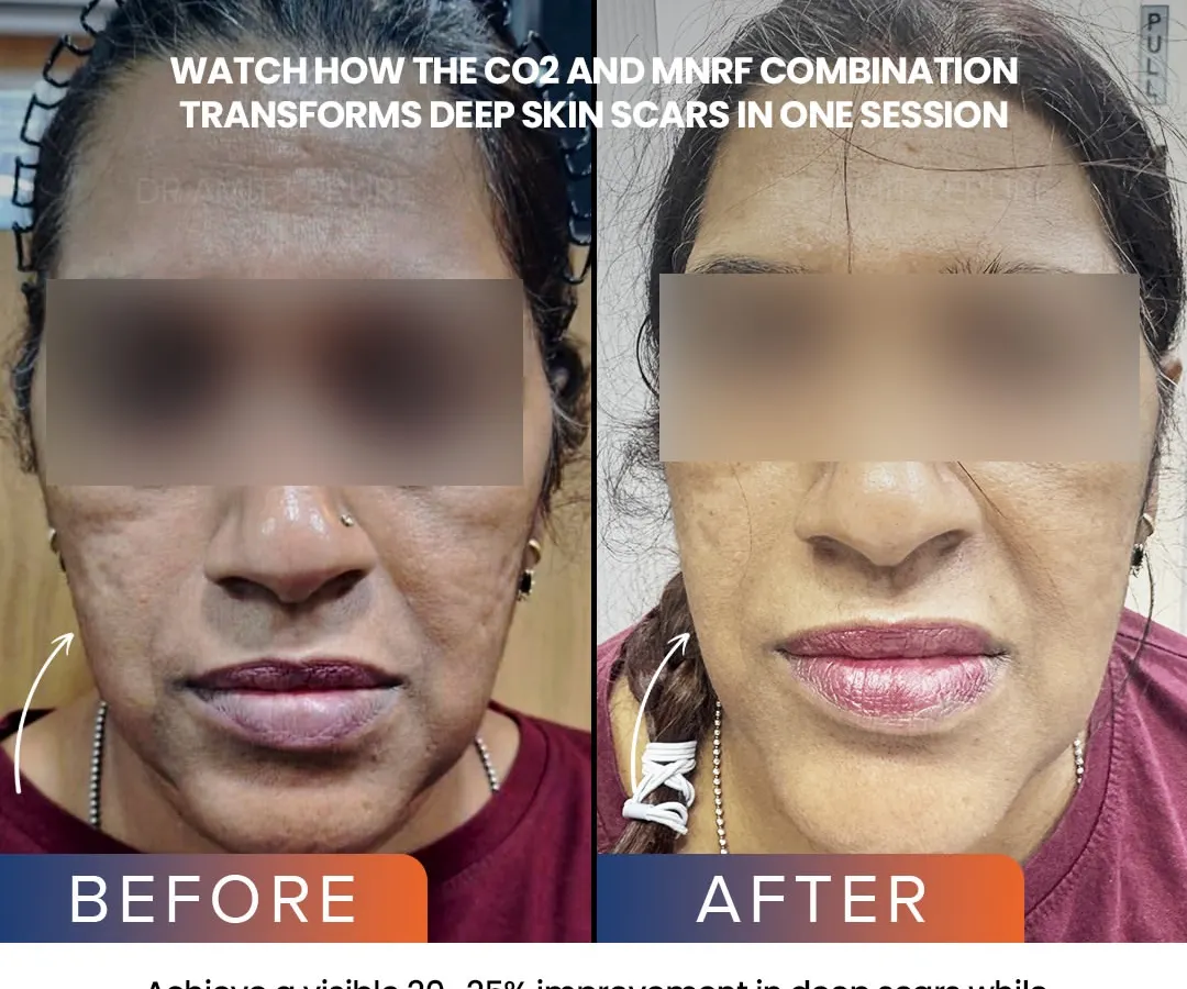 For deep, stubborn scars, I often combine treatments for the best results. This before-and-after shows a visible 20-25% improvement in deep scars after just one session combining CO2 Fractional Laser and MNRF, two powerful technologies that remodel the skin from within.